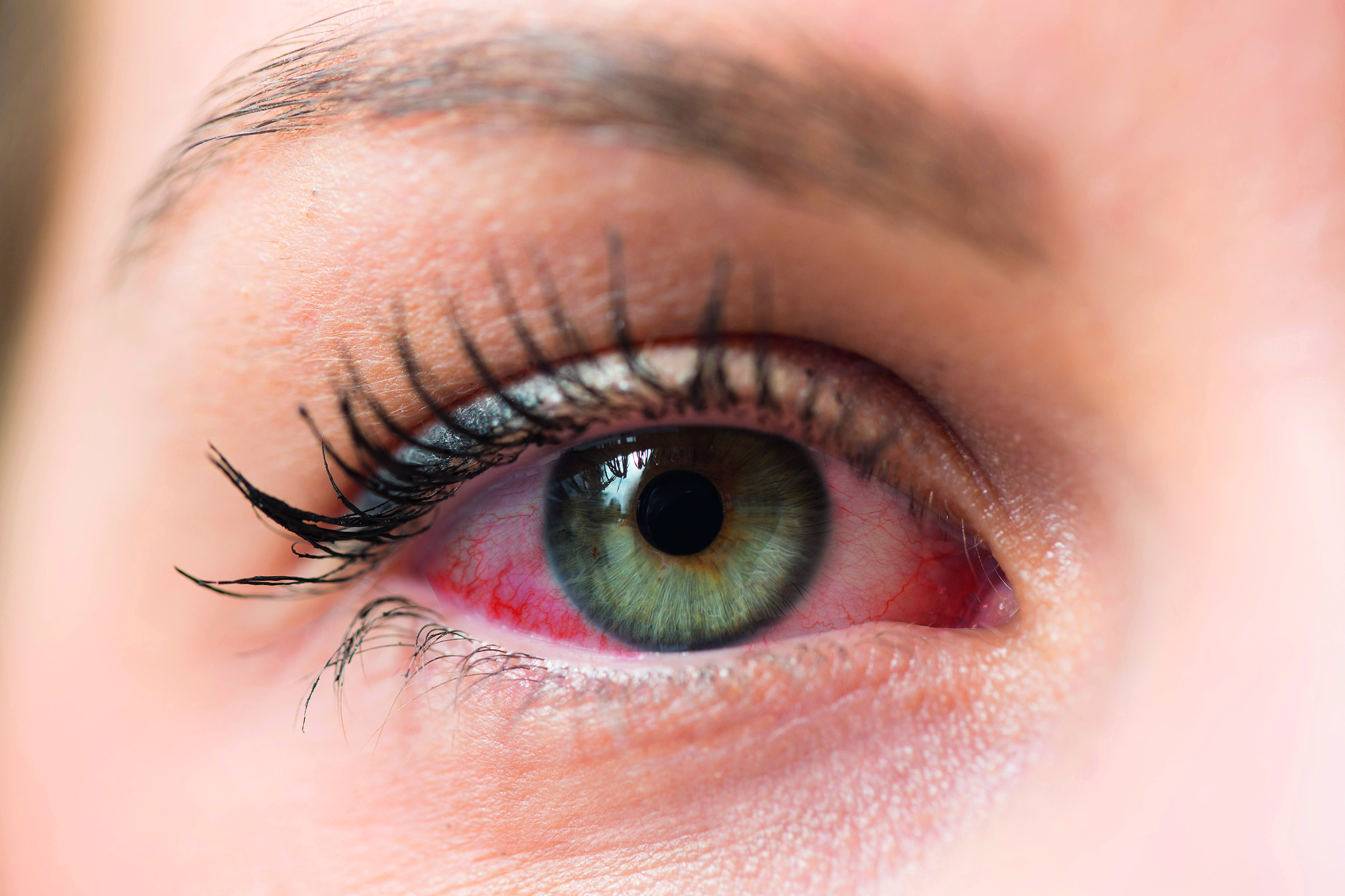 RETINOPATÍA DIABÉTICA Y PROBLEMAS DE SALUD VISUAL